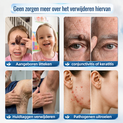Natravor® Geavanceerde Corrigerende Crème voor Huidflapjes, Moedervlekken & Vlekken – 7 Dagen Zonder Pijn & Zonder Littekens – Geavanceerde Verzorging voor Huidoneffenheden