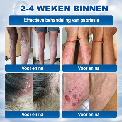 Natravor® Geavanceerde Corrigerende Crème voor Huidflapjes, Moedervlekken & Vlekken – 7 Dagen Zonder Pijn & Zonder Littekens – Geavanceerde Verzorging voor Huidoneffenheden