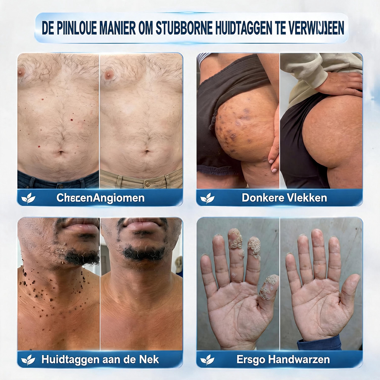 🔥🔥Officiële merkshop | 🖊️Natravor® 7-daagse wratten- en vlekkenverwijderaar (pijnstillende applicator voor nauwkeurig aanbrengen, laat geen littekens achter)🌳